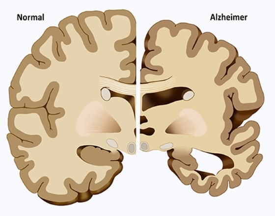 Porovnání struktury zdravého mozku (vpravo) a mozku postiženého Alzheimerovou chorobou (vlevo), zdroj: universiteitleiden.nl
